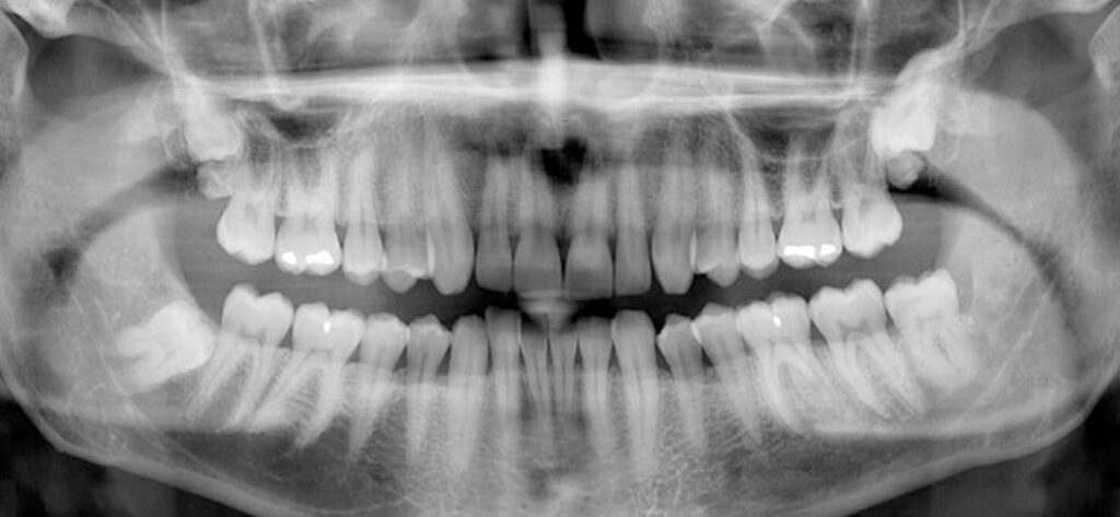 panoramic x ray thegem blog default 1024x473